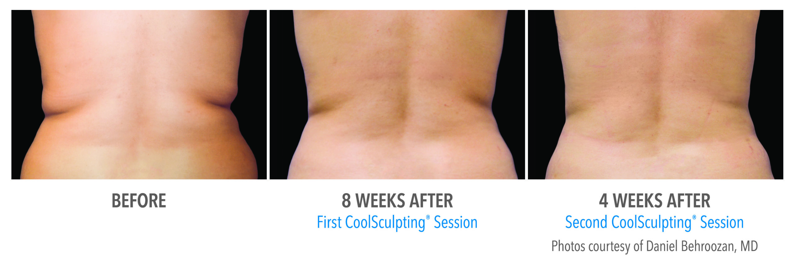 Coolsculpting treatments newmarket