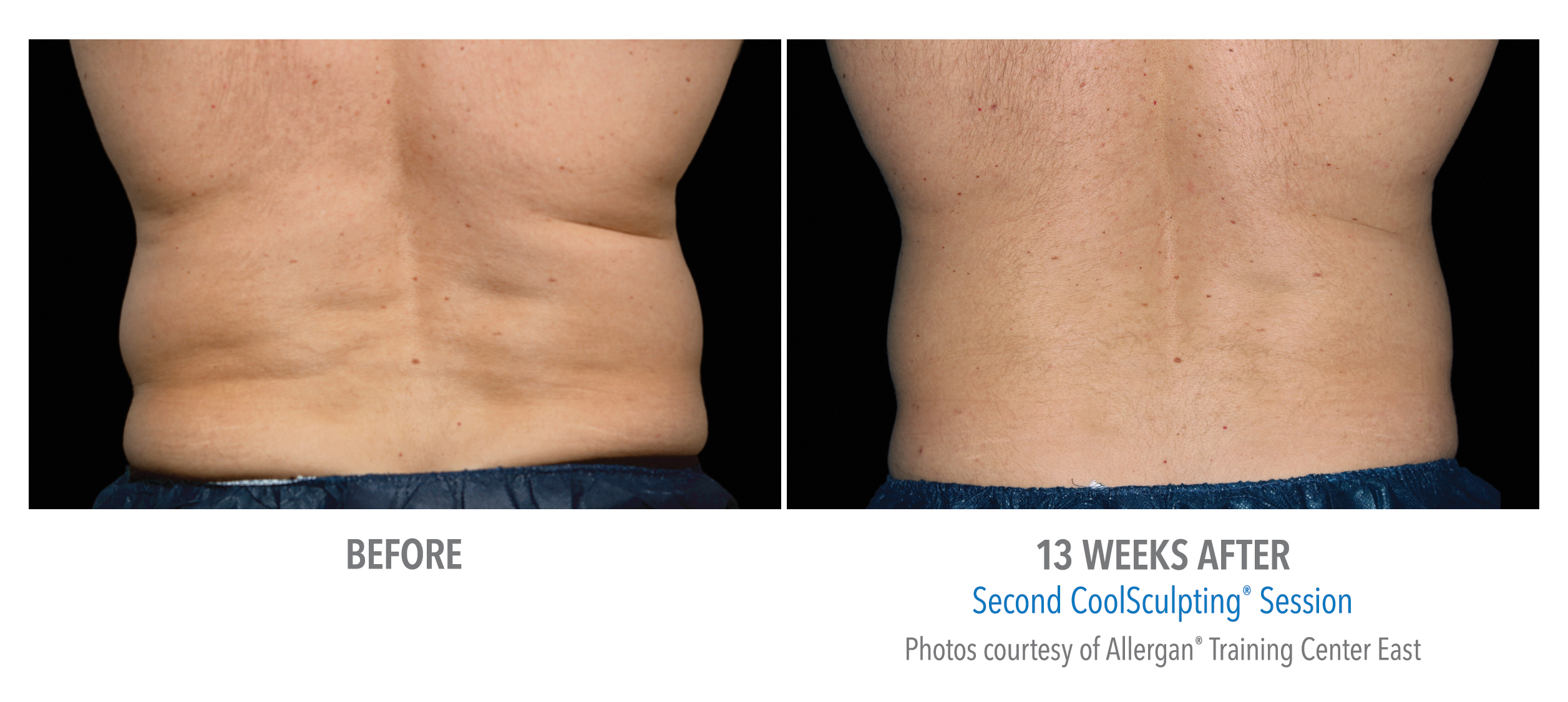 Coolsculpting procedure fat removal