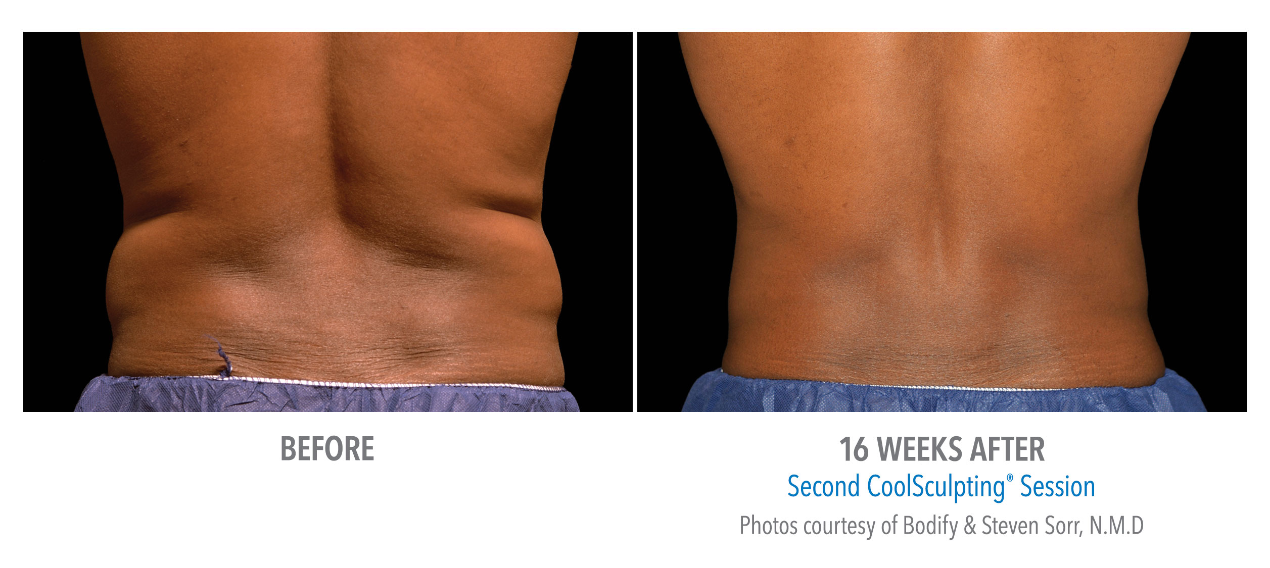 Coolsculpting before and after newmarket