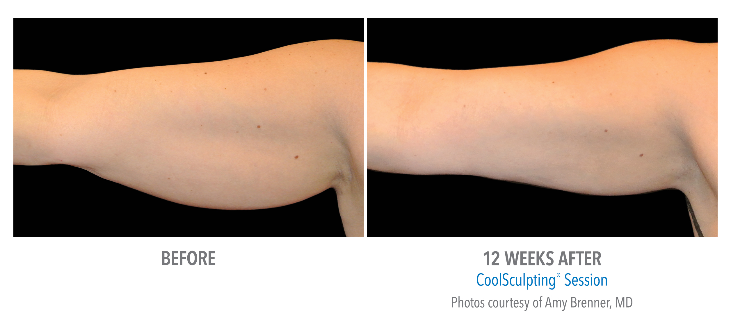 Target fat cells coolsculpting