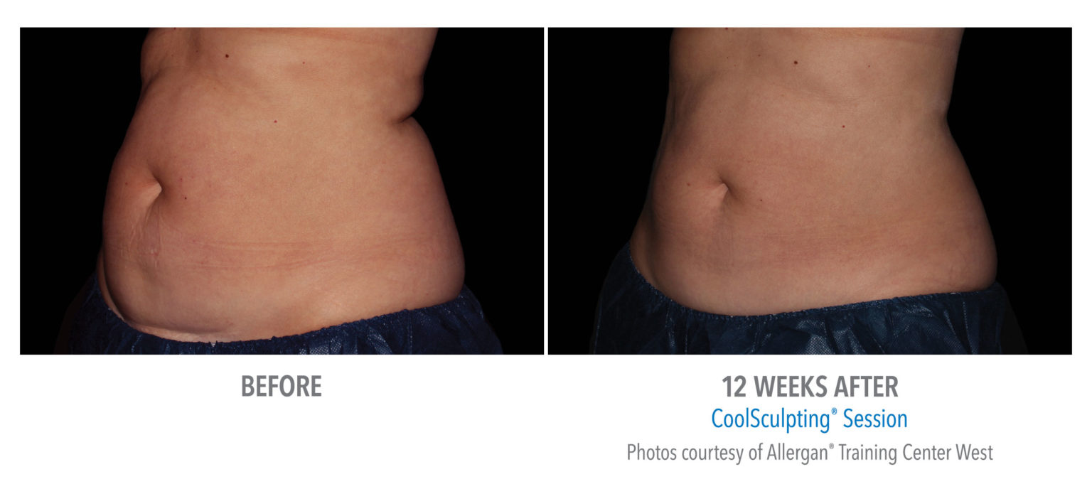 Coolsculpting months after treatment