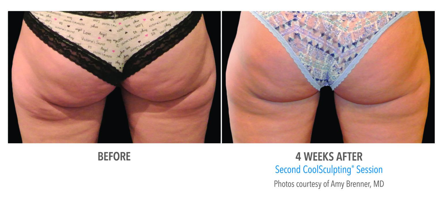 Does coolsculpting work newmarket