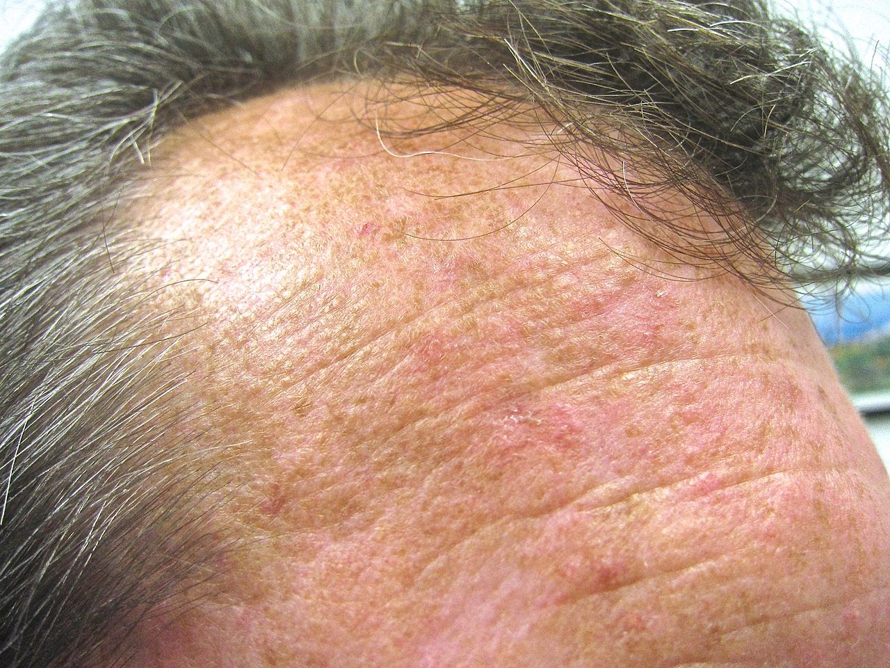 actinic keratosis on scalp