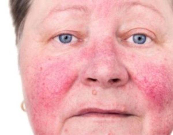 A woman with rosacea flare-ups on her face.