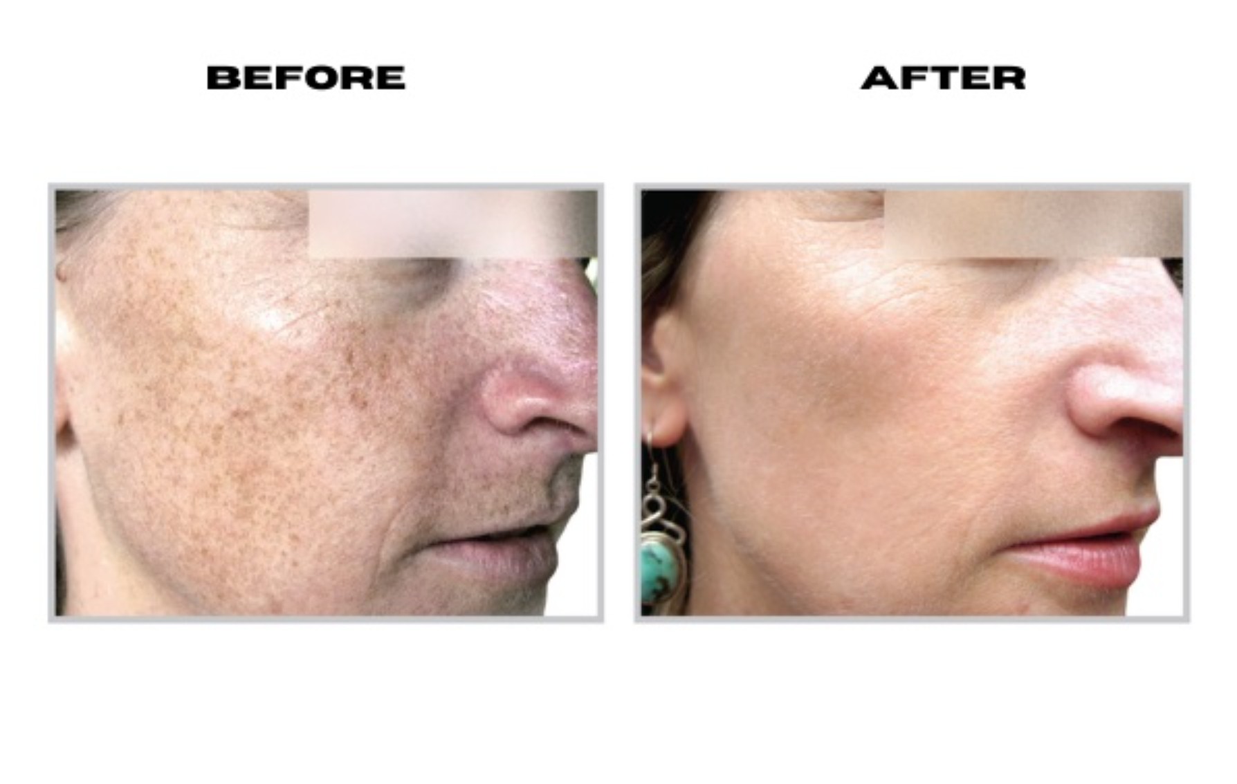 HALO hybrid fractional laser before and after pictures