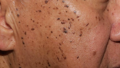 A close-up shot of an older man with seborrheic keratosis, a form of hyperpigmentation.