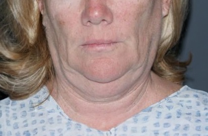 Lower half of a woman’s face with jowls and residual face fat.