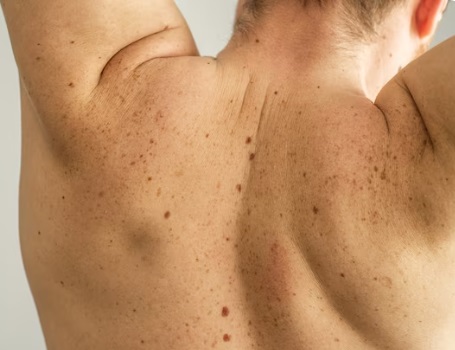 Close-up of back skin showing moles and lesions – Healthy Skin Effective Treatments for Moles, Lesions, and More.