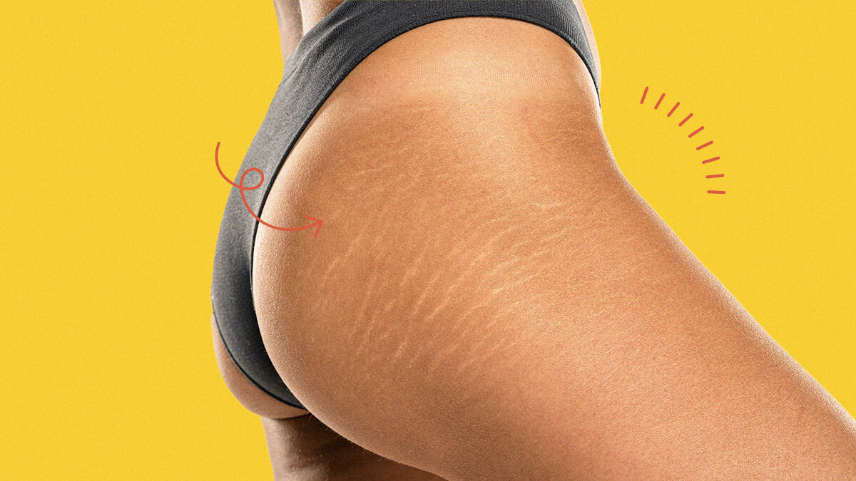 Side view of a woman’s upper thighs with stretch marks against a yellow background.