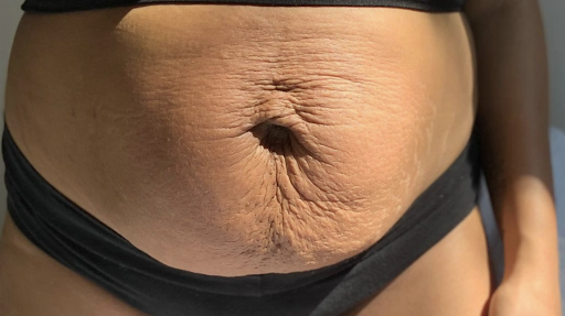 Close-up shot of a woman’s abdomen with visible sagging and wrinkles.